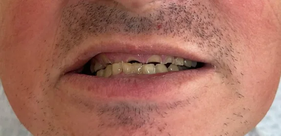 Smile Design πριν στο Smile Atelier