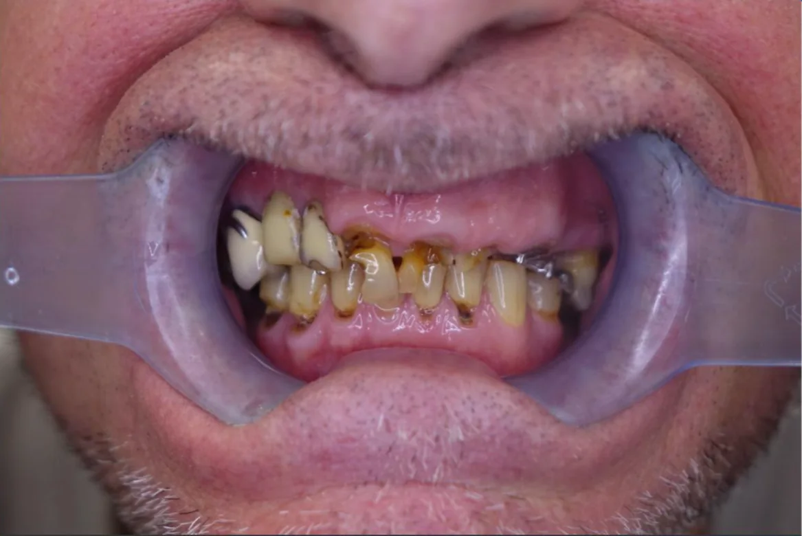 Πριν από θεραπεία veneers στο Smile Atelier Χαλκιδική