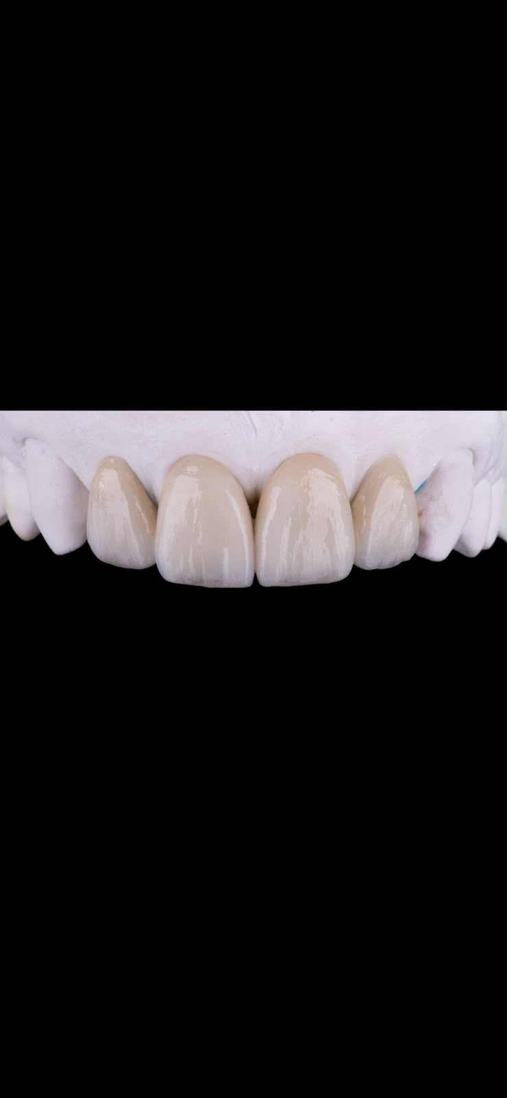 Prosthetic dental work and ceramic teeth for restorative dentistry at Smile Atelier