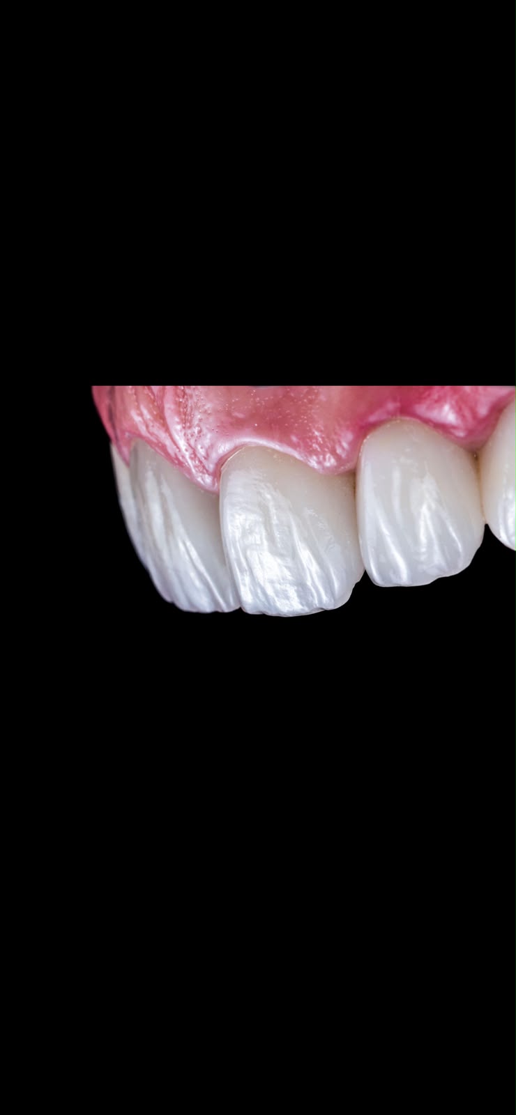 Porcelain veneers for Smile Design treatment at Smile Atelier